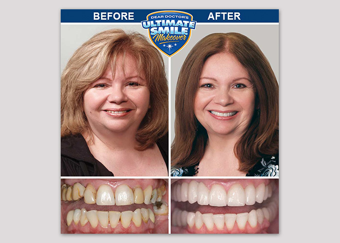 Debra Ultimate Smile Makeover