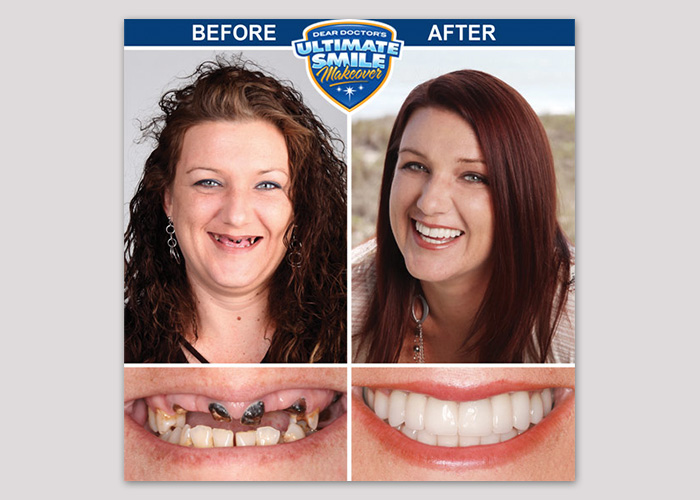 Heather Ultimate Smile Makeover