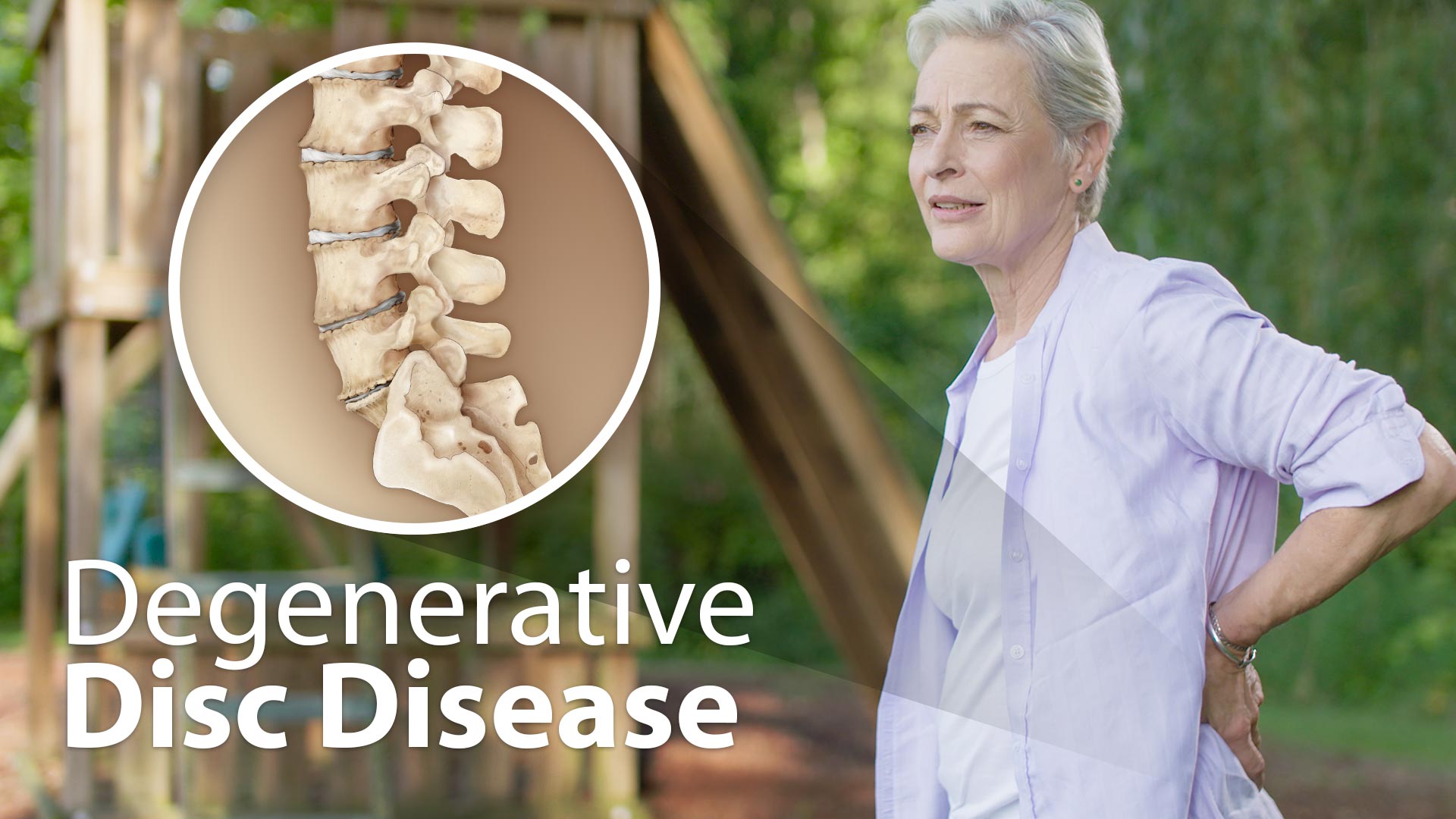 Degenerative Disc