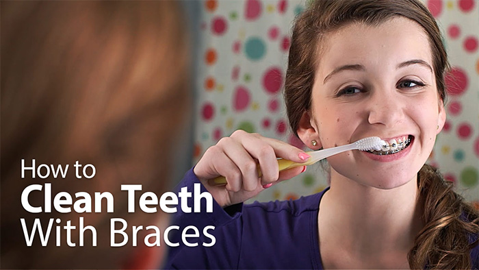 Brushing with Braces